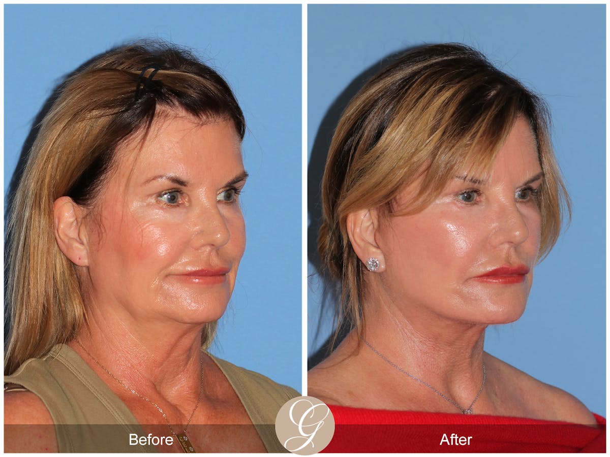 Deep Plane Facelift Before & After Gallery - Patient 238097 - Image 9