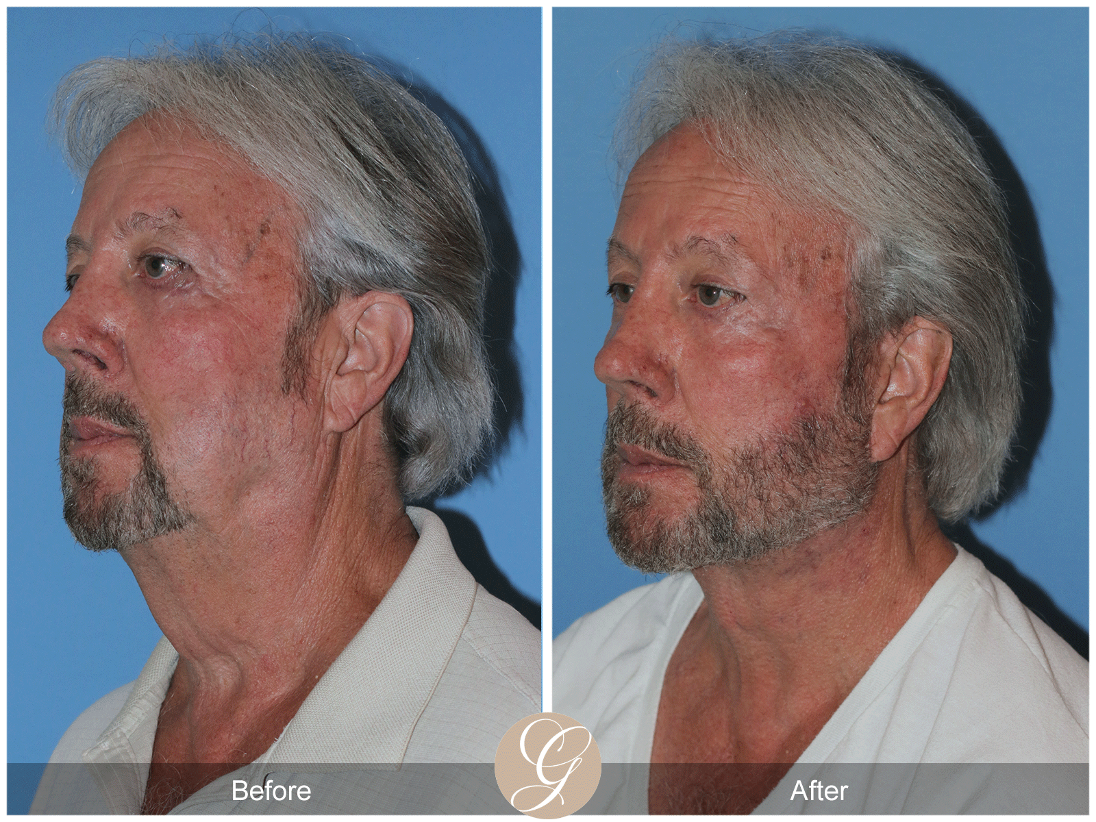 Facelift B&A