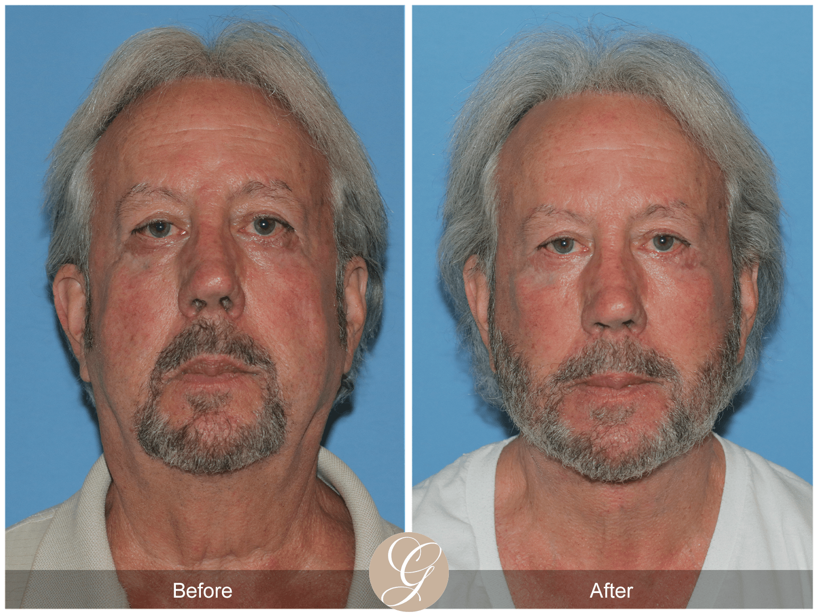 Facelift B&A