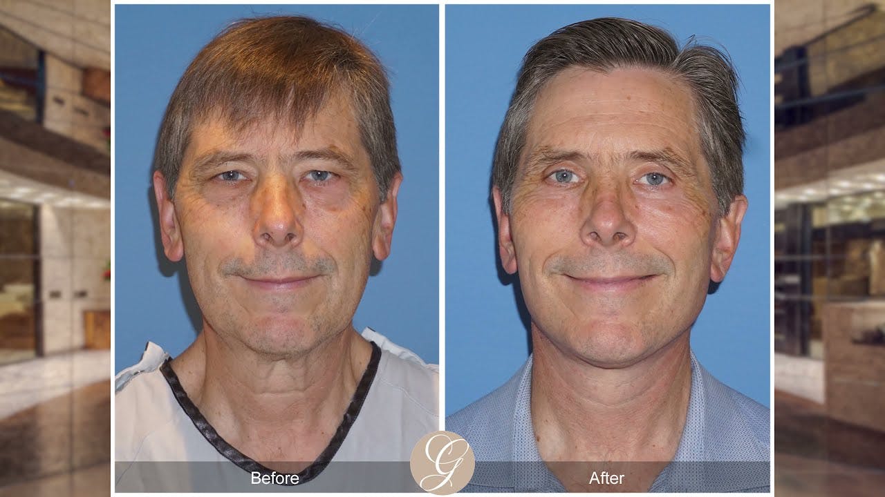 Real Facelift Patient Before and After Photos