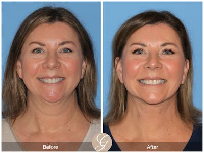 Preservation Facelift Before & After Gallery - Patient 491704 - Image 1