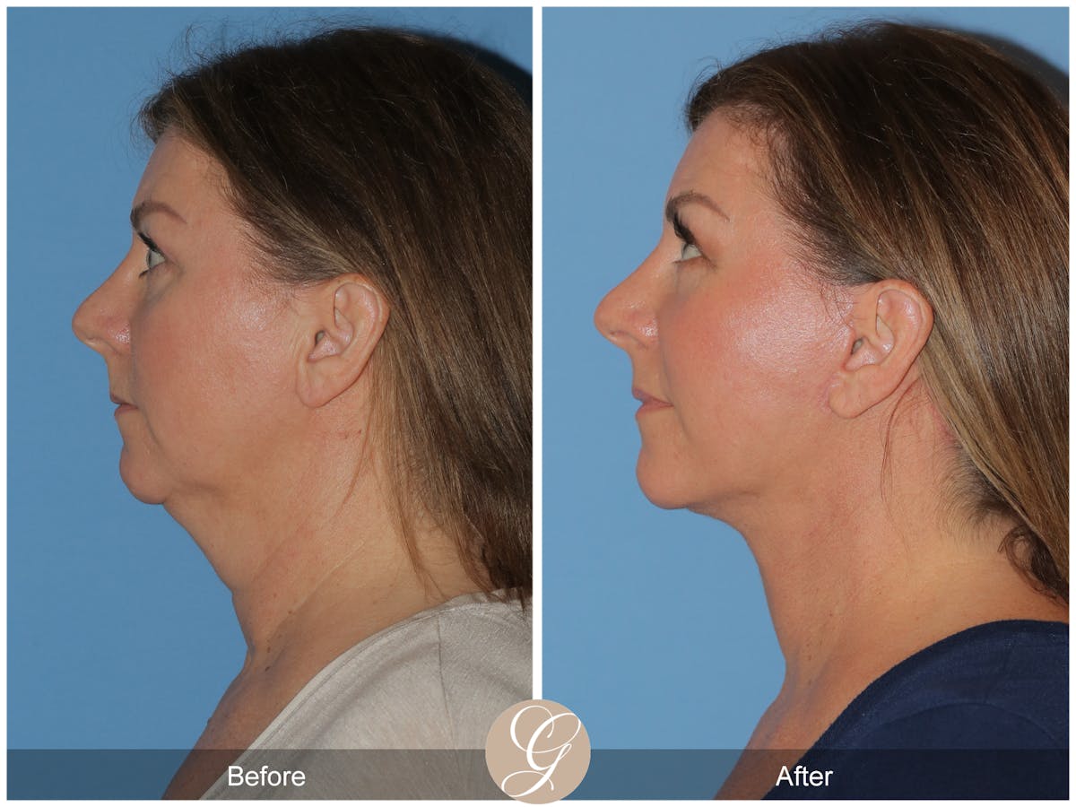 Preservation Facelift Before & After Gallery - Patient 491704 - Image 3