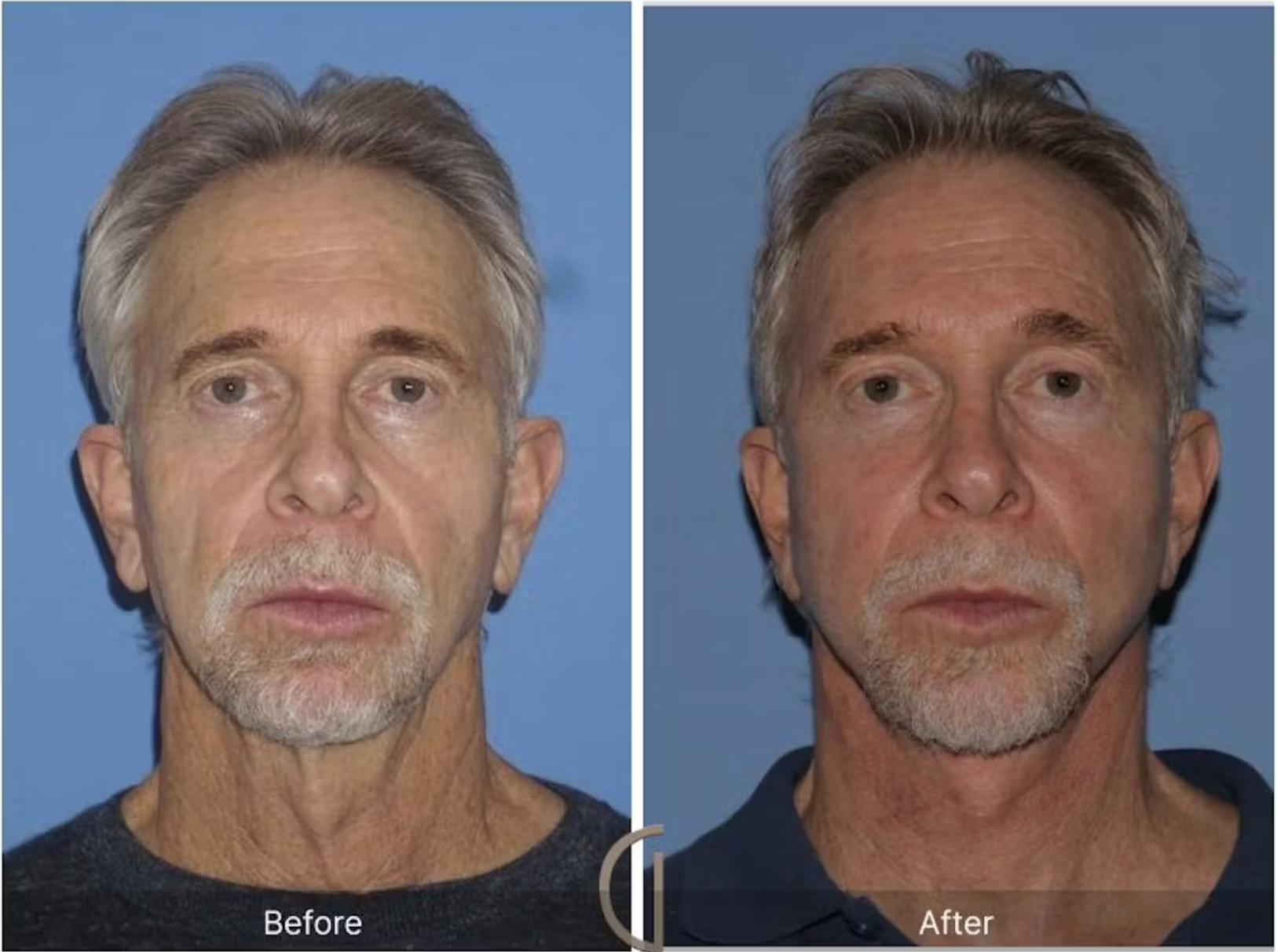Facelift B&A
