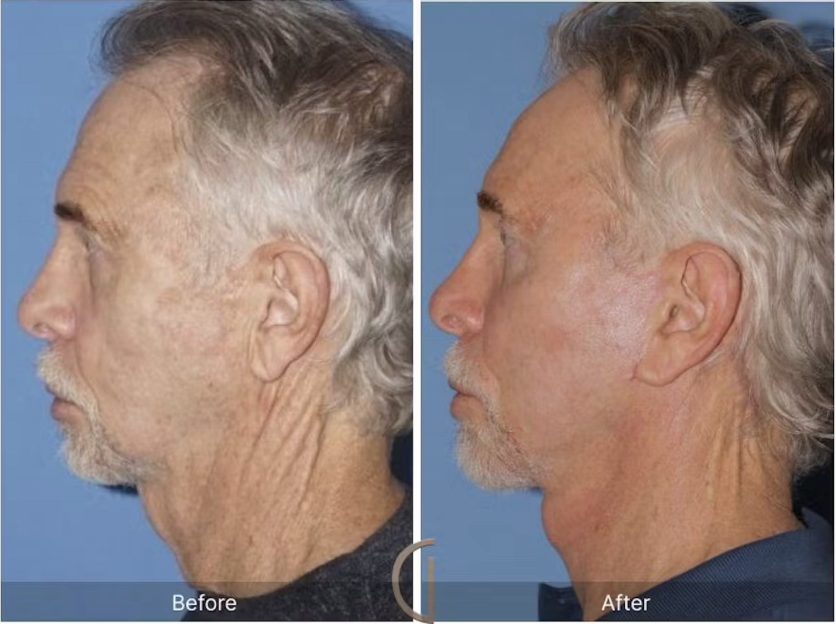 Facelift B&A