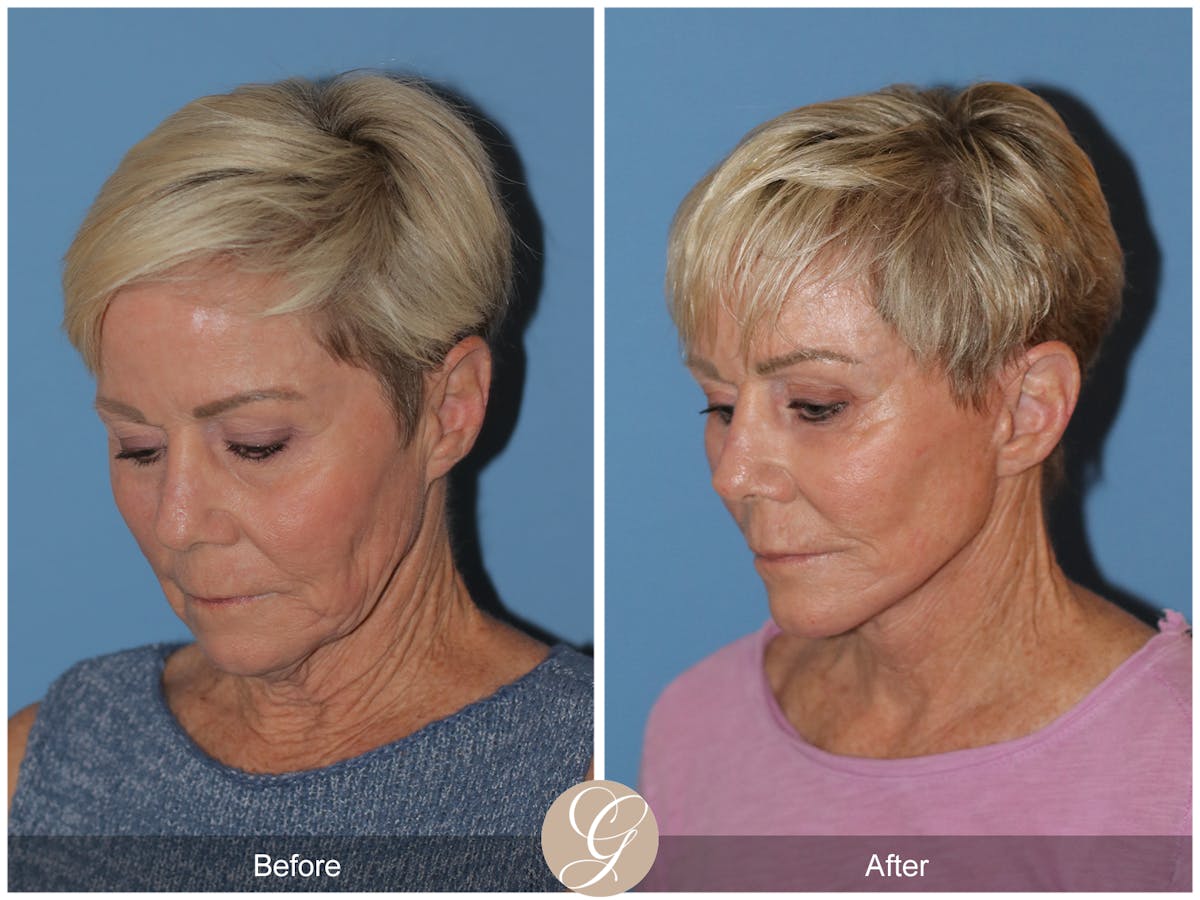 Neck Lift Before & After Gallery - Patient 182330 - Image 2