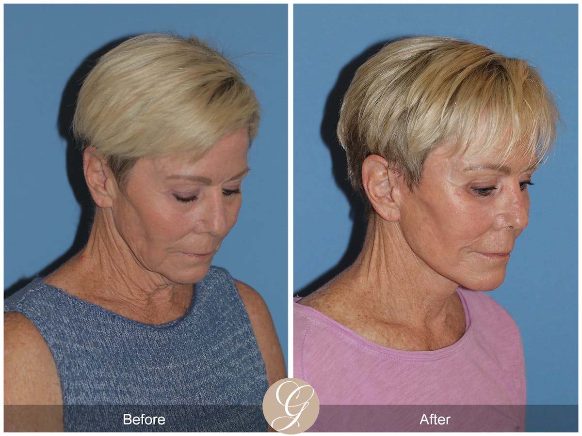 Neck Lift Before & After Gallery - Patient 182330 - Image 6
