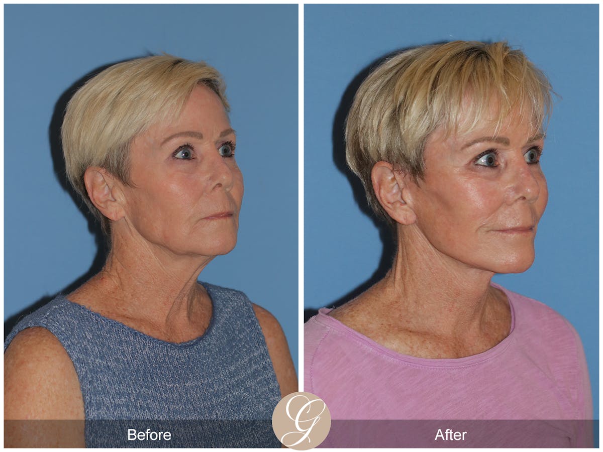 Neck Lift Before & After Gallery - Patient 182330 - Image 5