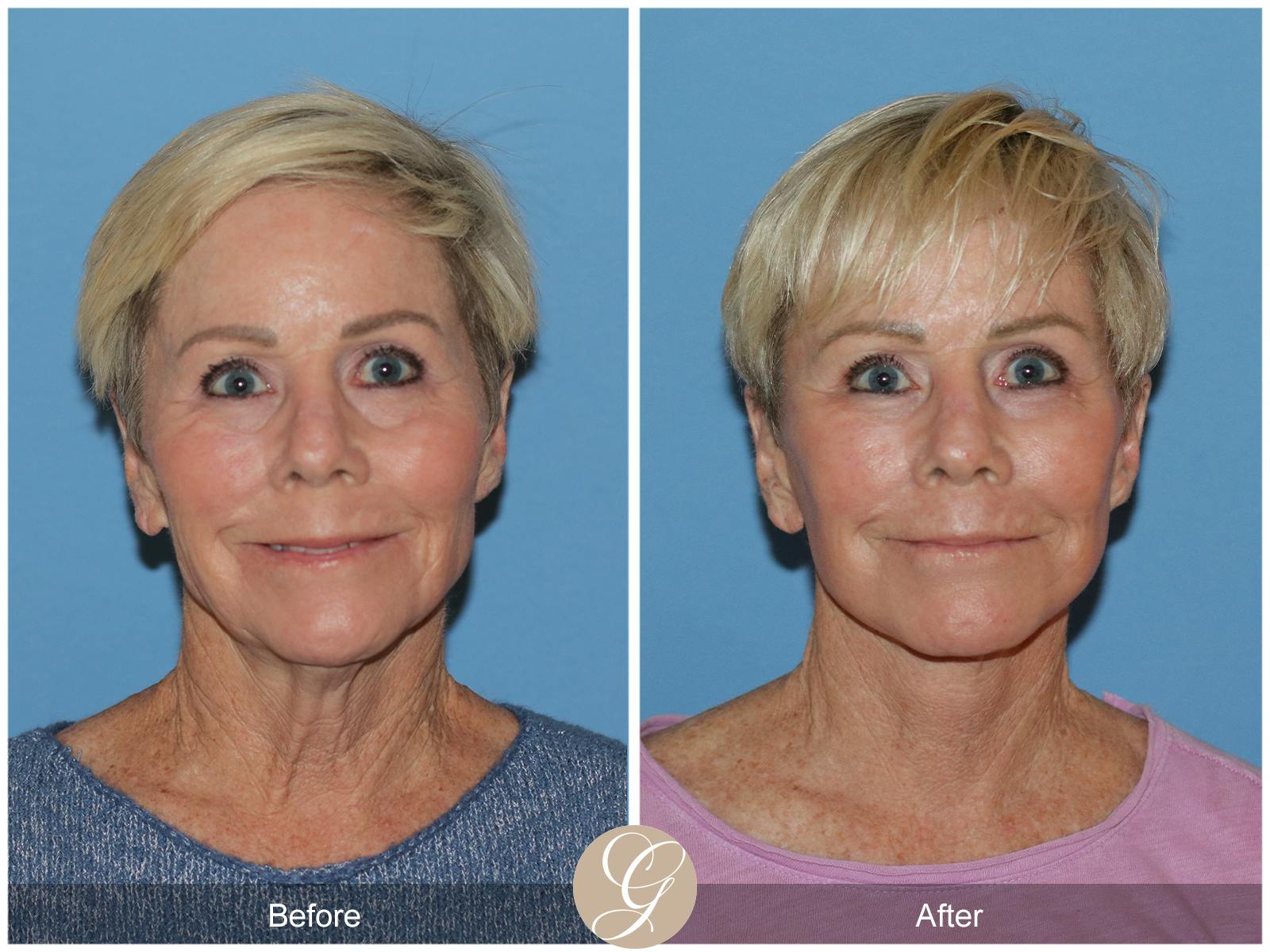Neck Lift Before & After Gallery - Patient 182330 - Image 3
