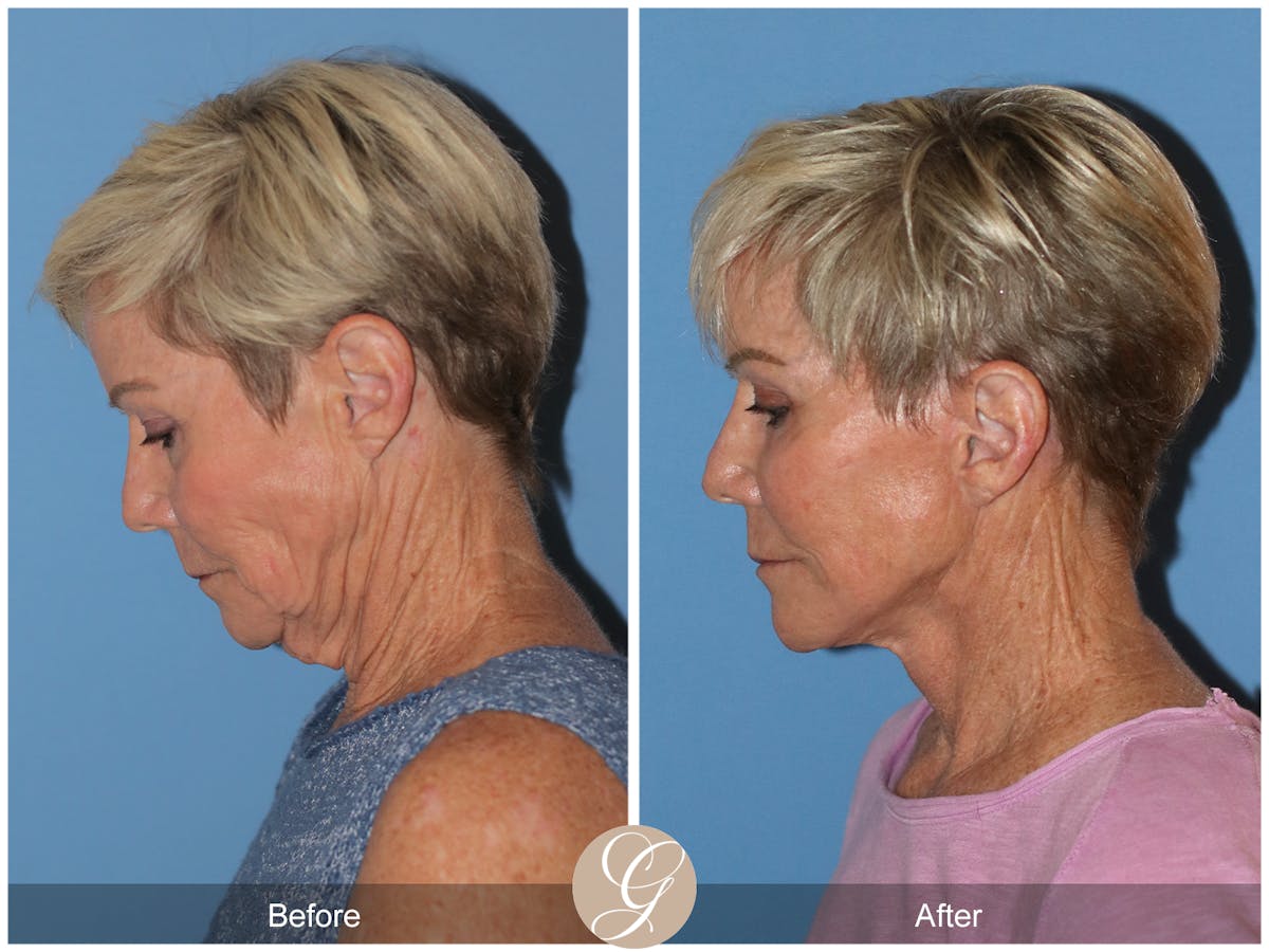 Neck Lift Before & After Gallery - Patient 182330 - Image 1