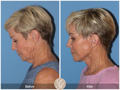 Neck Lift Before & After Gallery - Patient 182330 - Image 1