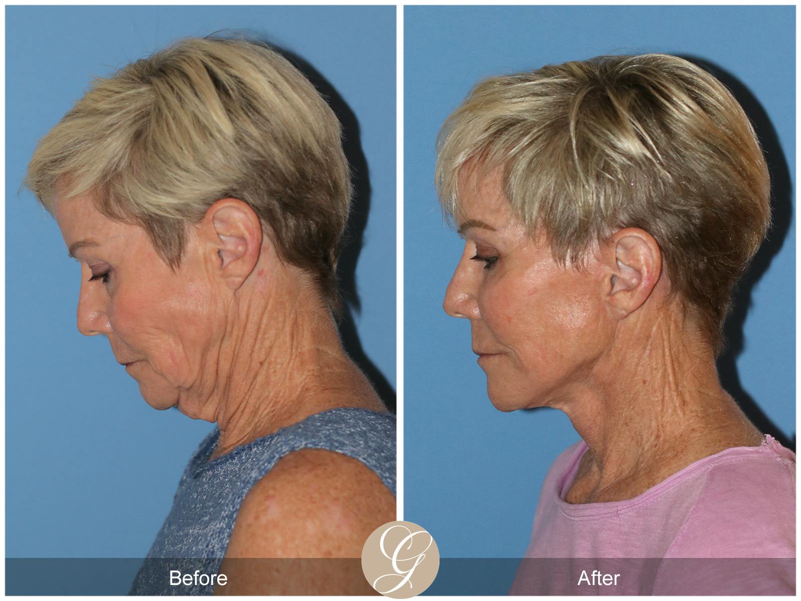 Neck Lift Before & After Gallery - Patient 182330 - Image 1