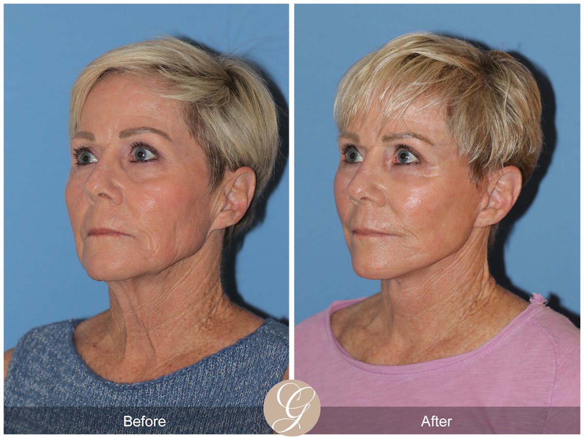 Neck Lift Before & After Gallery - Patient 182330 - Image 7