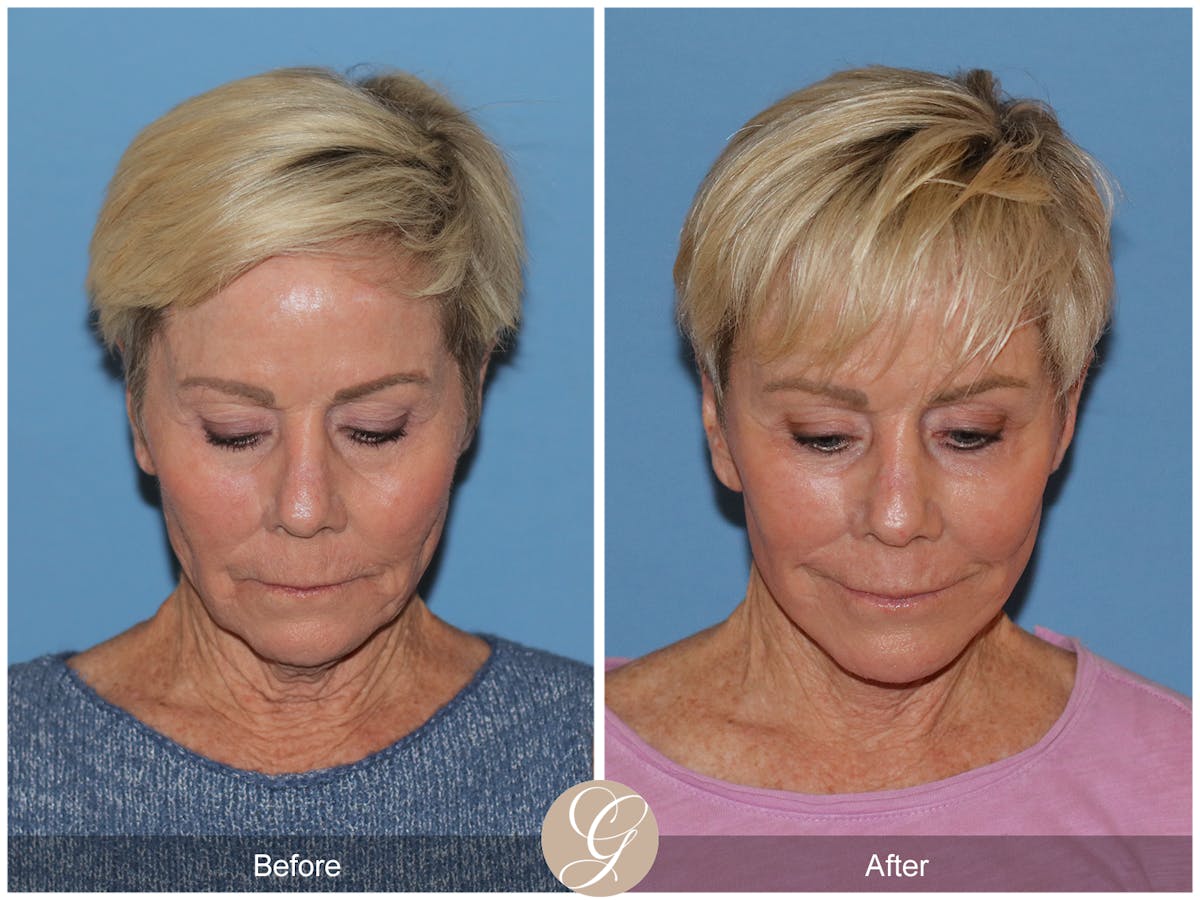 Neck Lift Before & After Gallery - Patient 182330 - Image 4