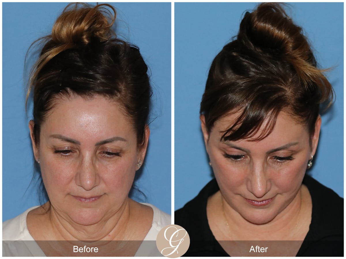 Neck Lift Before & After Gallery - Patient 328545 - Image 5