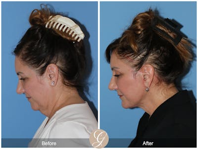 Neck Lift Before & After Gallery - Patient 328545 - Image 1