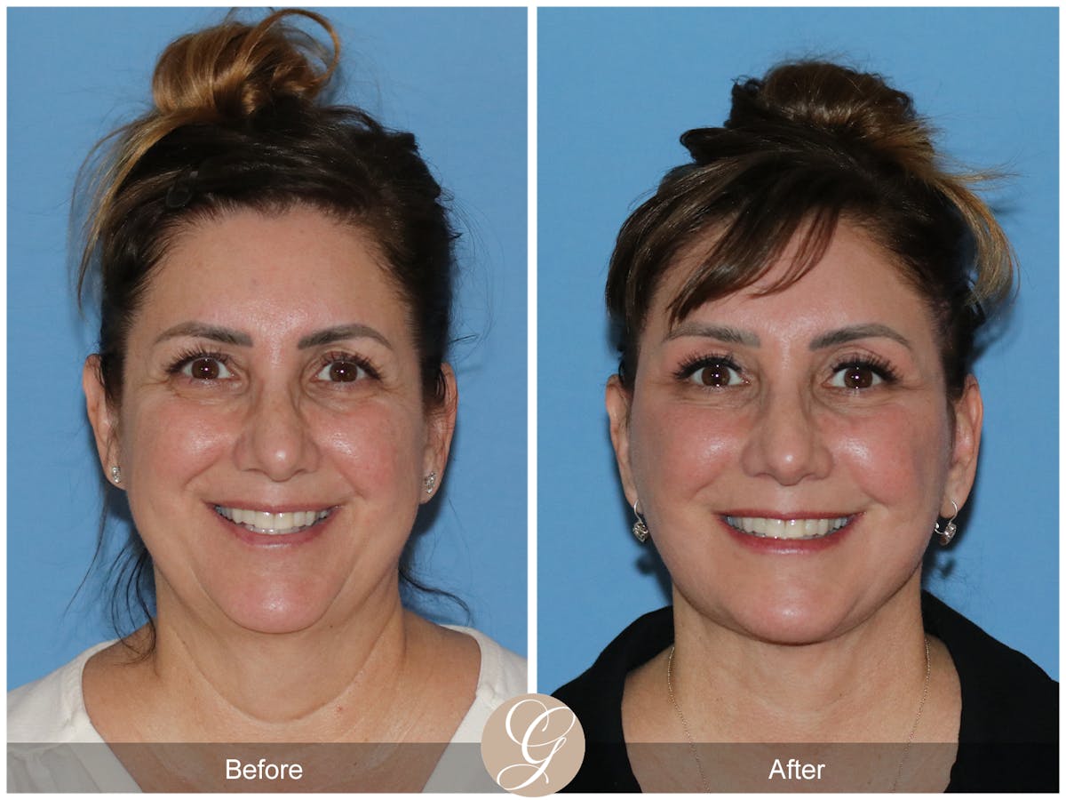 Neck Lift Before & After Gallery - Patient 328545 - Image 4
