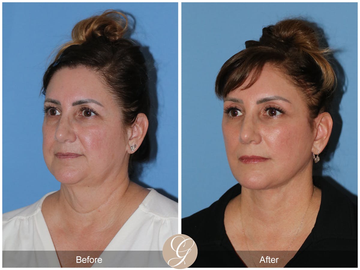 Neck Lift Before & After Gallery - Patient 328545 - Image 2