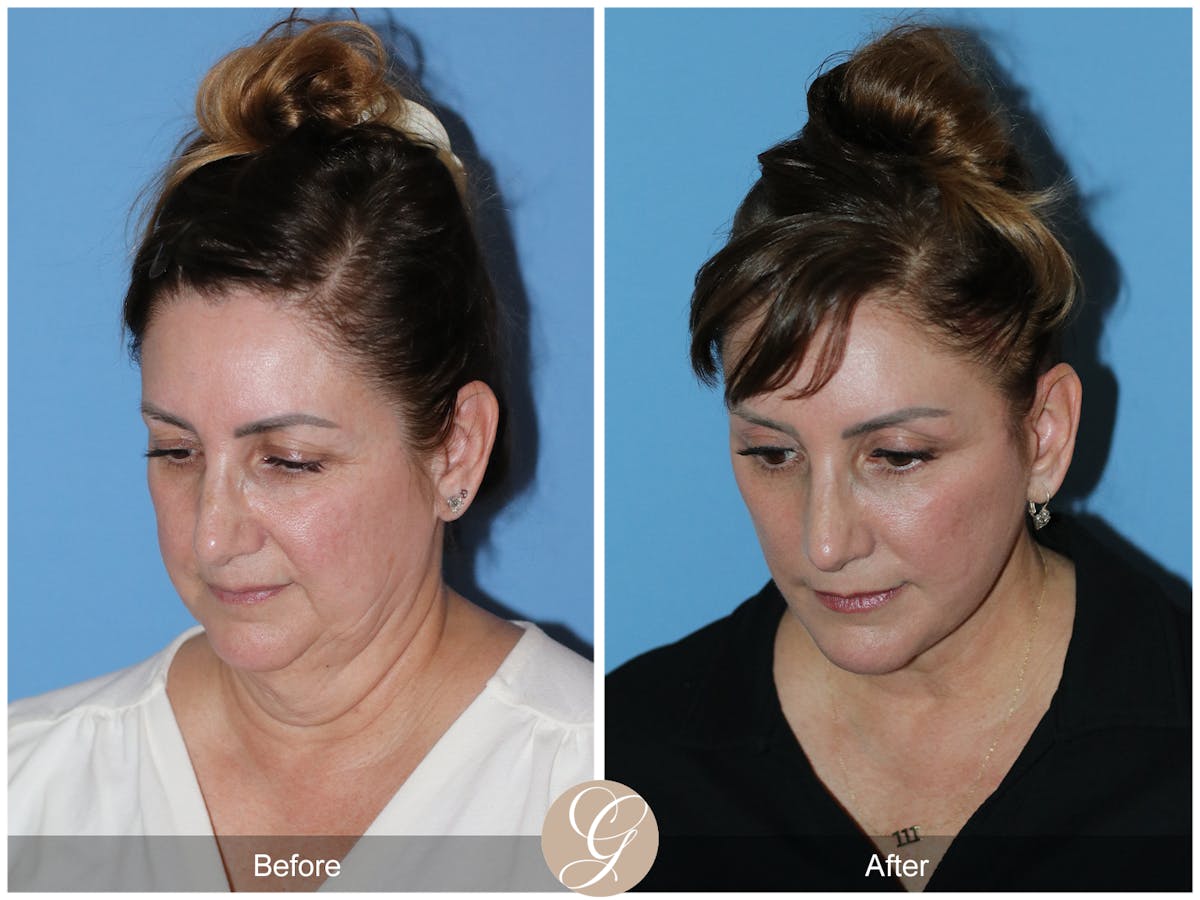 Neck Lift Before & After Gallery - Patient 328545 - Image 8