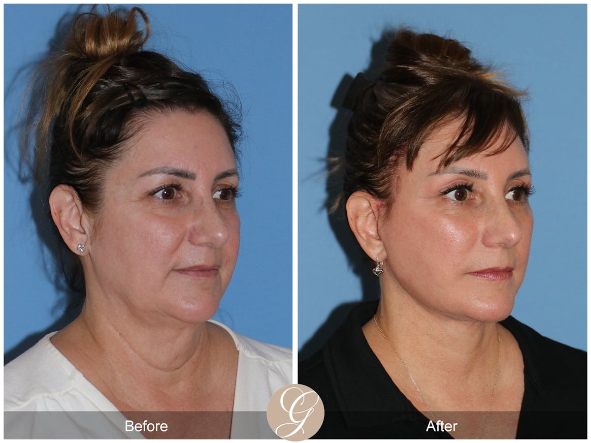 Neck Lift Before & After Gallery - Patient 328545 - Image 6