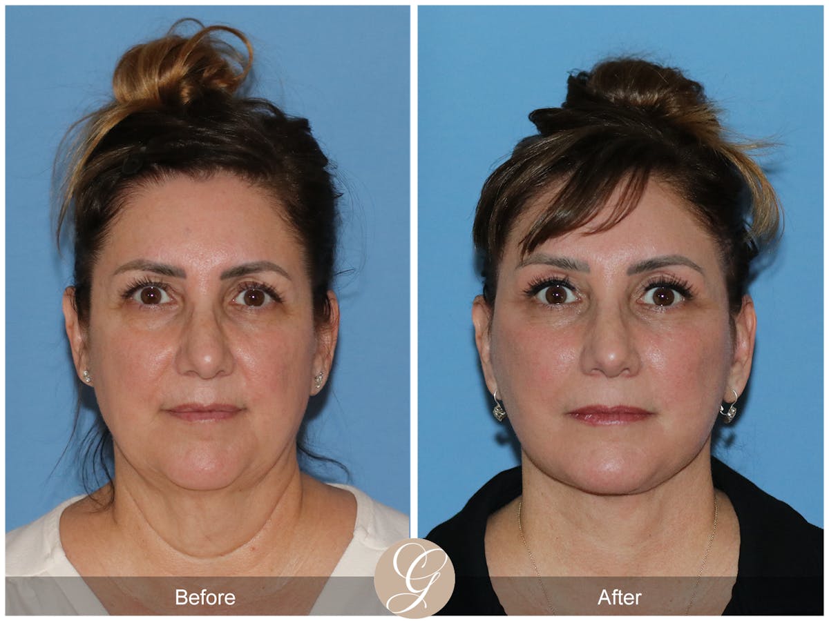 Neck Lift Before & After Gallery - Patient 328545 - Image 3