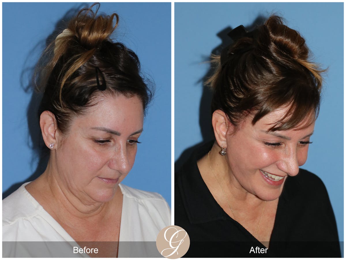 Neck Lift Before & After Gallery - Patient 328545 - Image 7