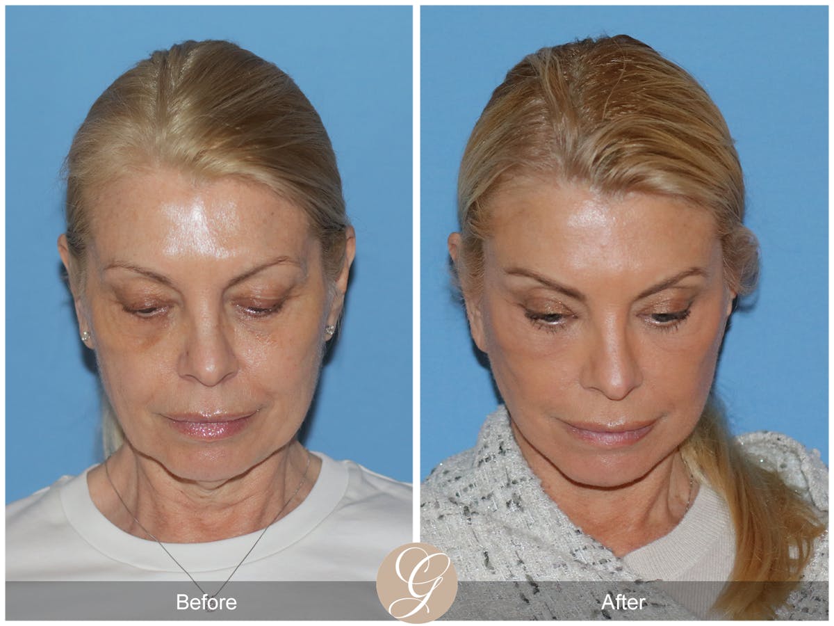 Neck Lift Before & After Gallery - Patient 222642 - Image 5