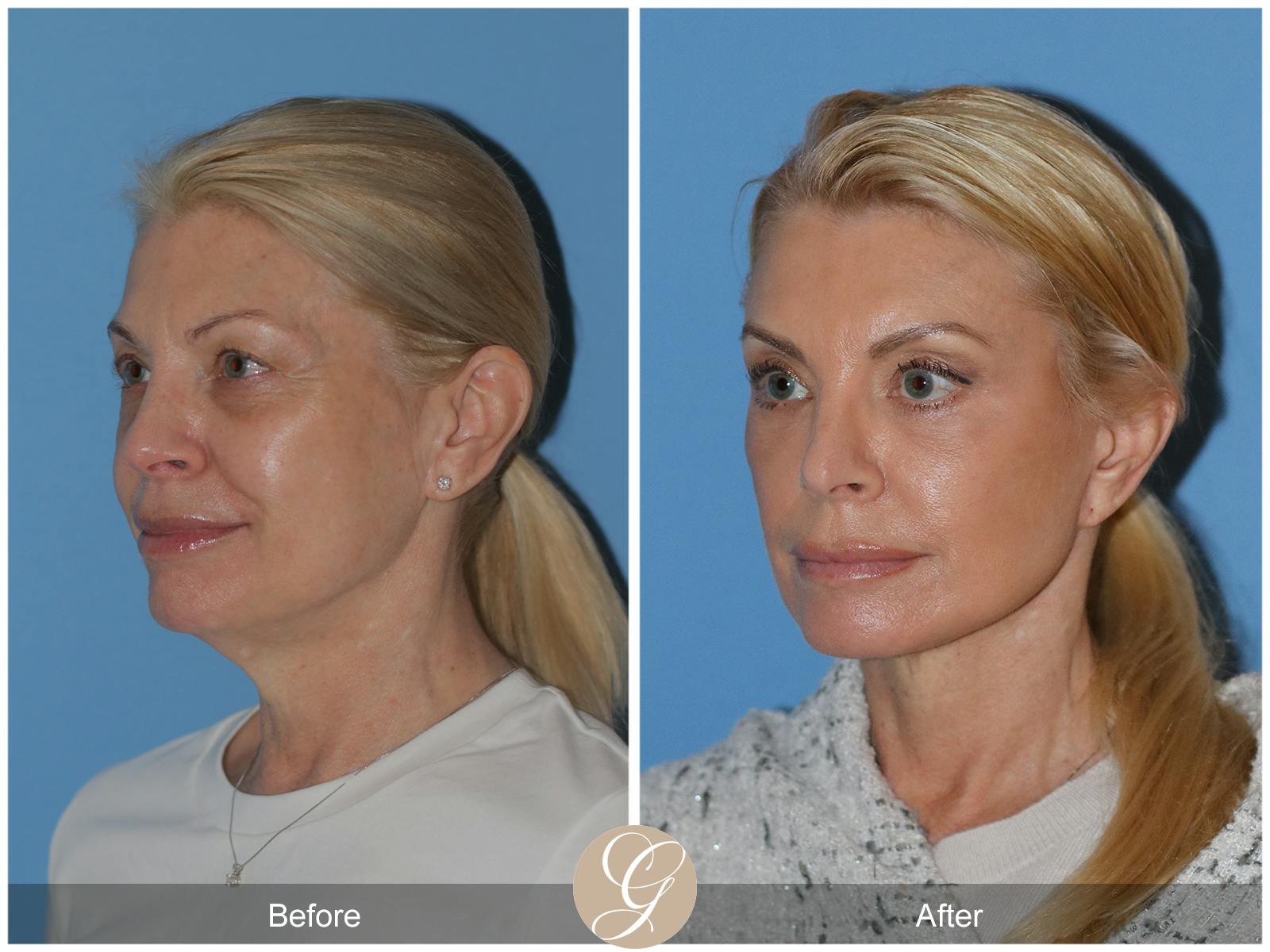 Neck Lift Before & After Gallery - Patient 222642 - Image 9