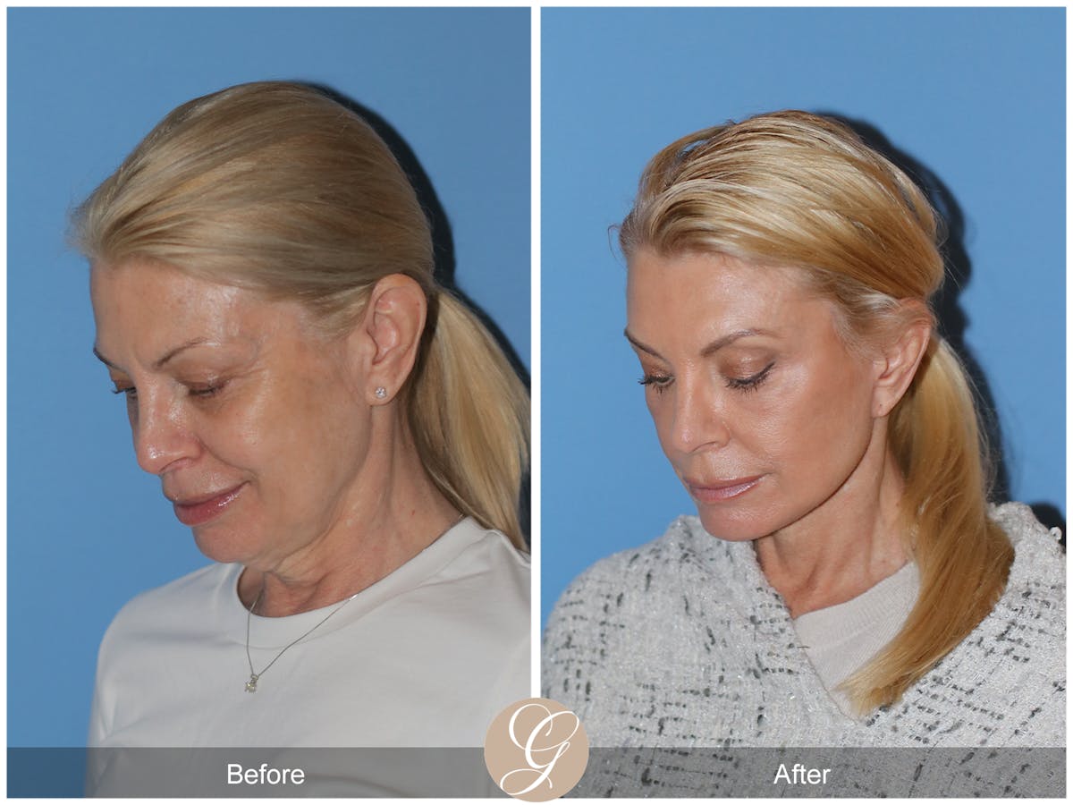 Neck Lift Before & After Gallery - Patient 222642 - Image 3