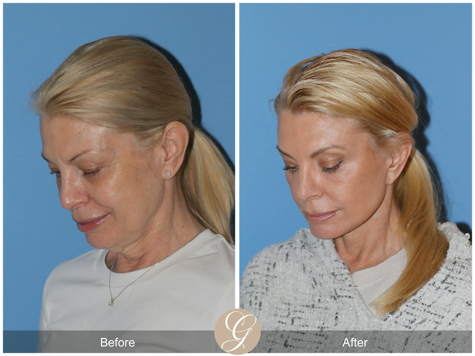Neck Lift Before & After Gallery - Patient 222642 - Image 3