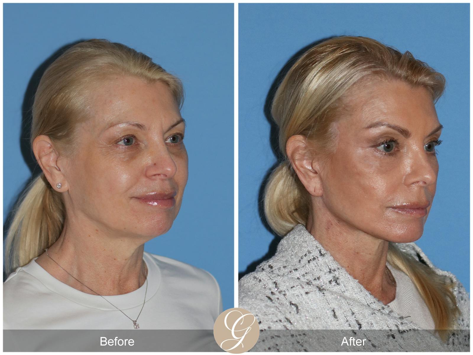 Neck Lift Before & After Gallery - Patient 222642 - Image 6