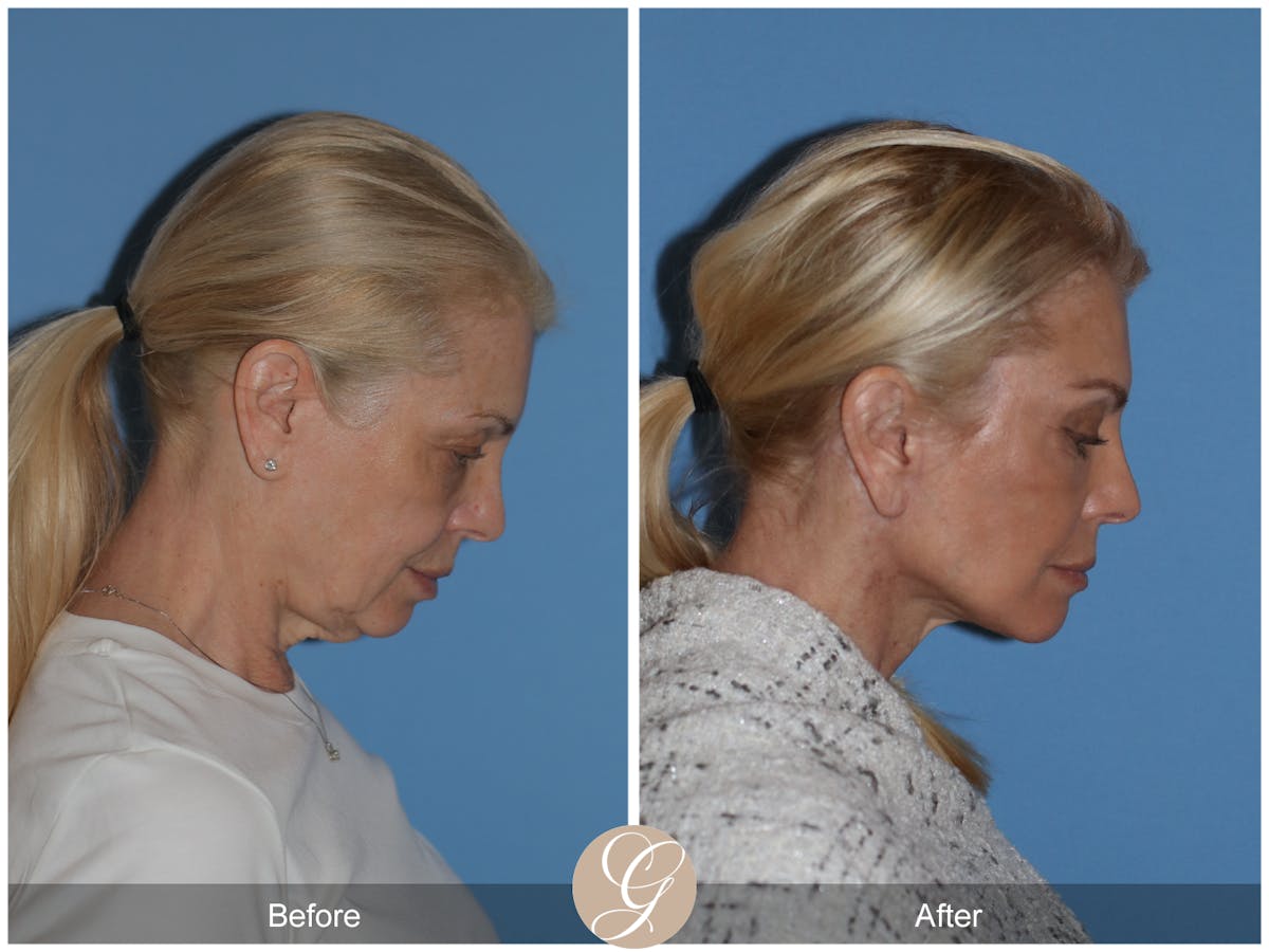 Neck Lift Before & After Gallery - Patient 222642 - Image 8