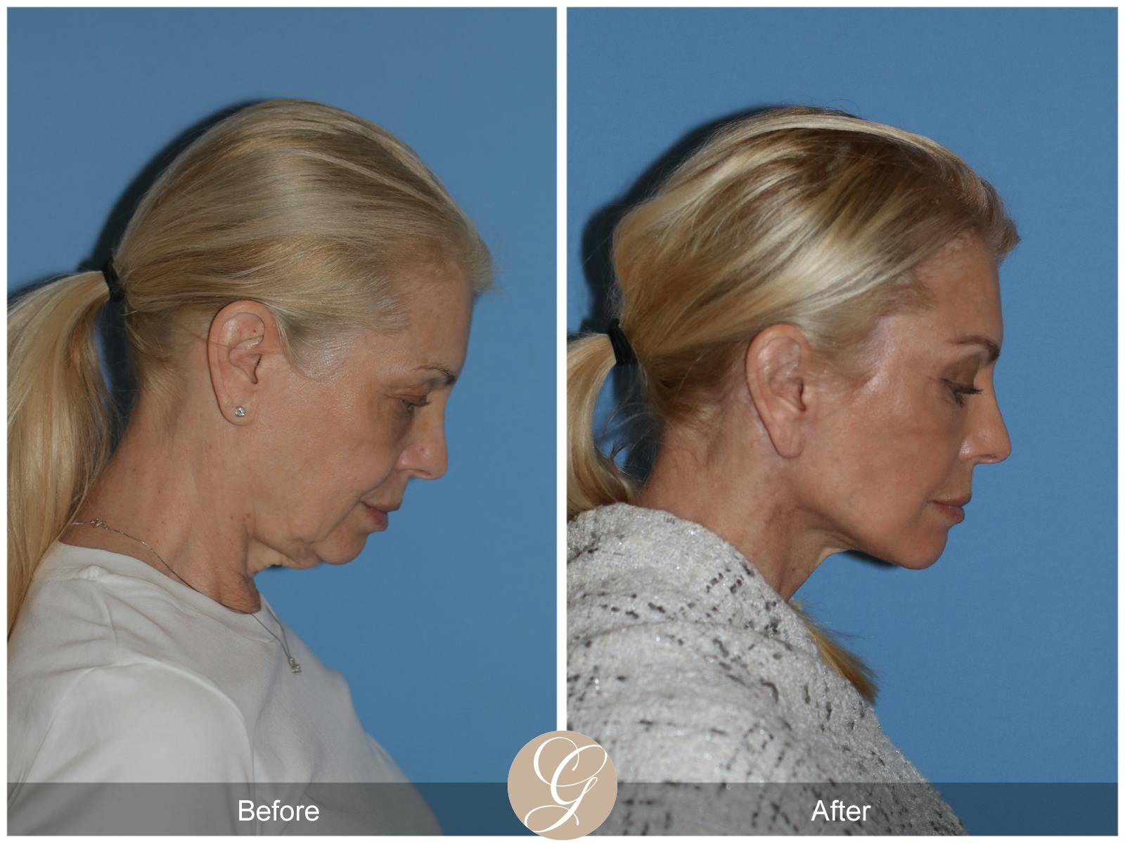 Neck Lift Before & After Gallery - Patient 222642 - Image 8
