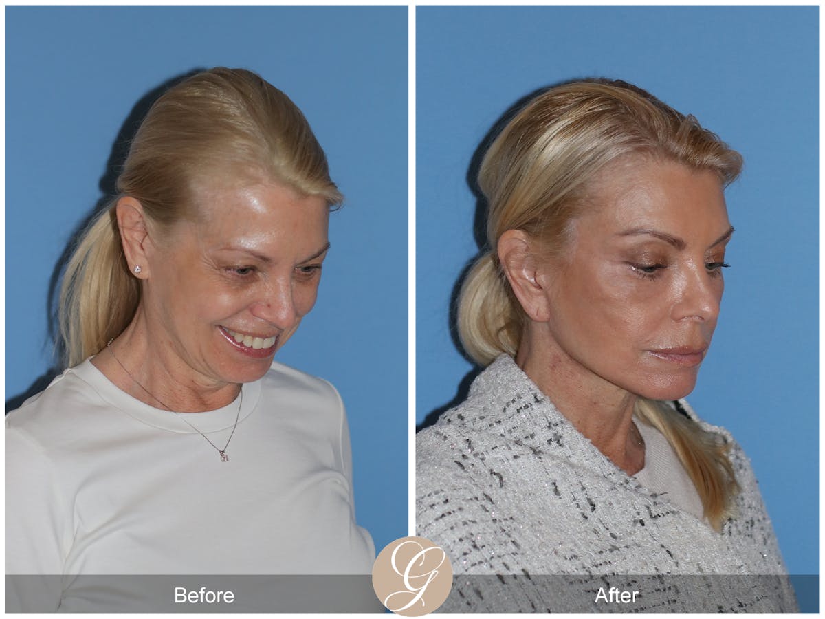 Neck Lift Before & After Gallery - Patient 222642 - Image 7