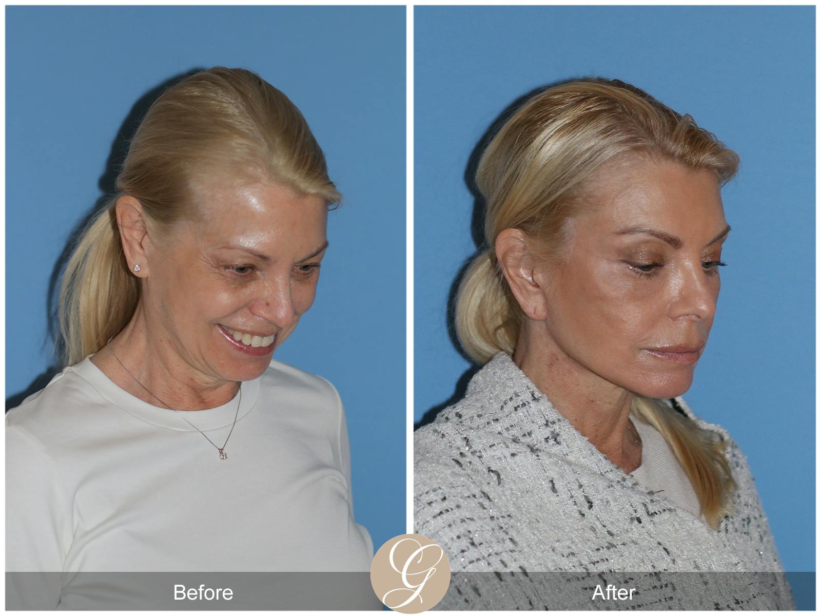 Neck Lift Before & After Gallery - Patient 222642 - Image 7