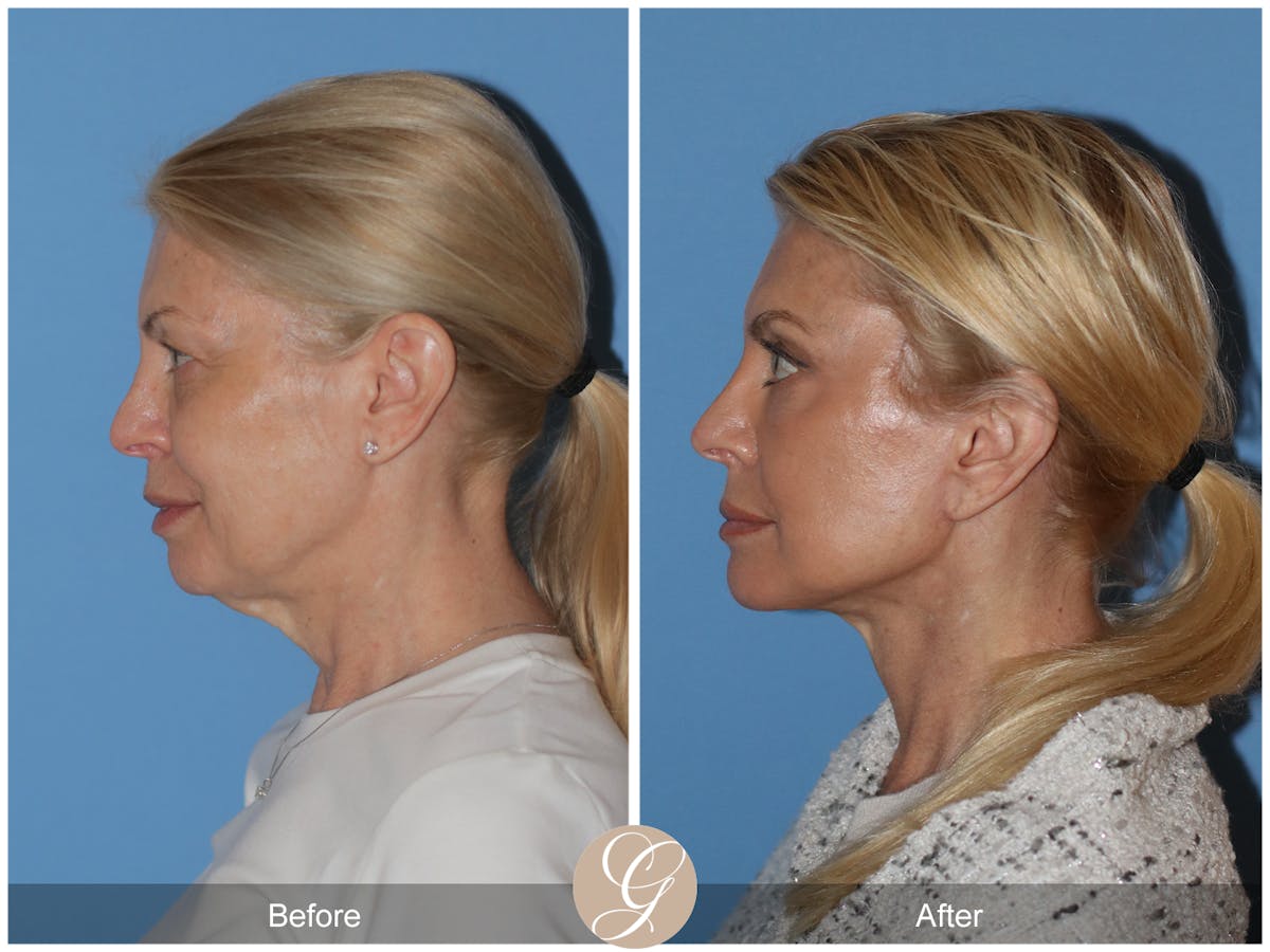 Neck Lift Before & After Gallery - Patient 222642 - Image 1