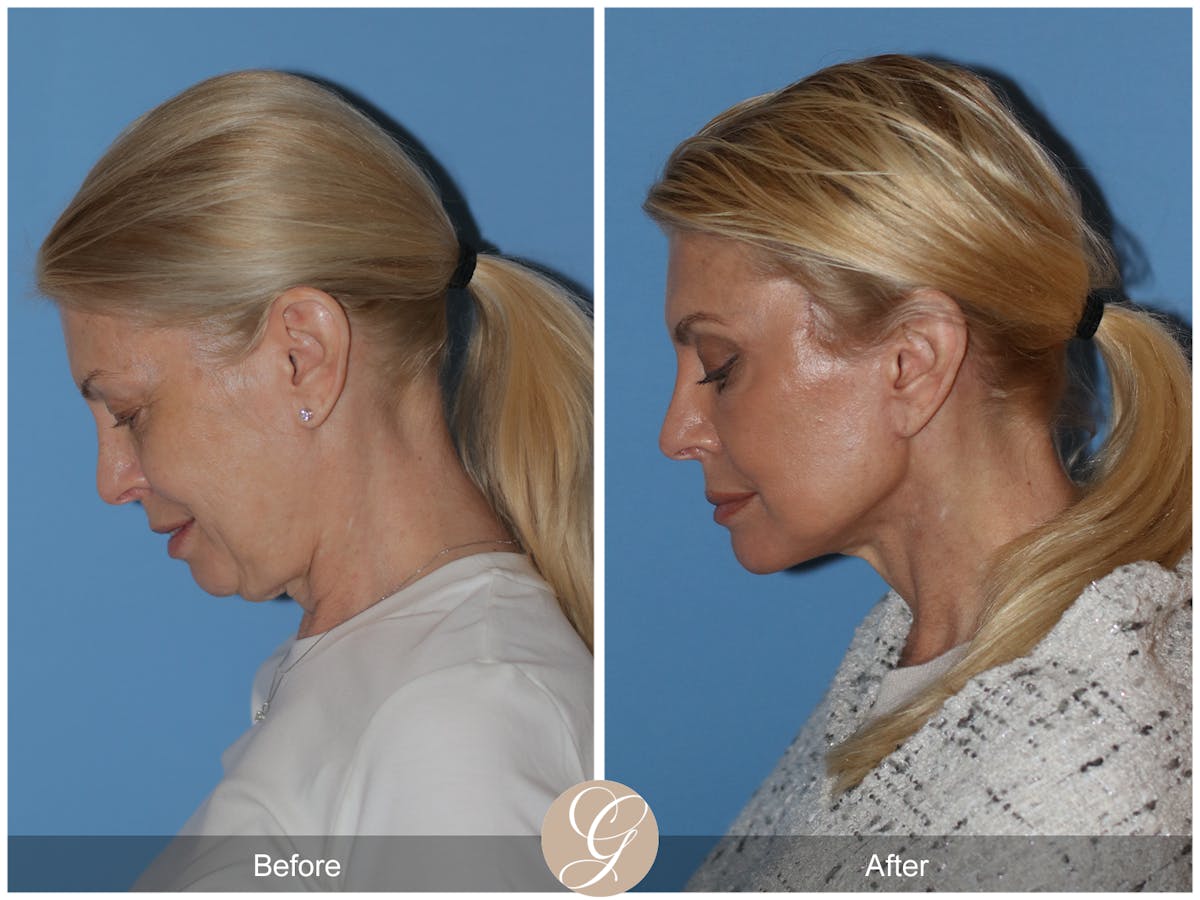 Neck Lift Before & After Gallery - Patient 222642 - Image 2