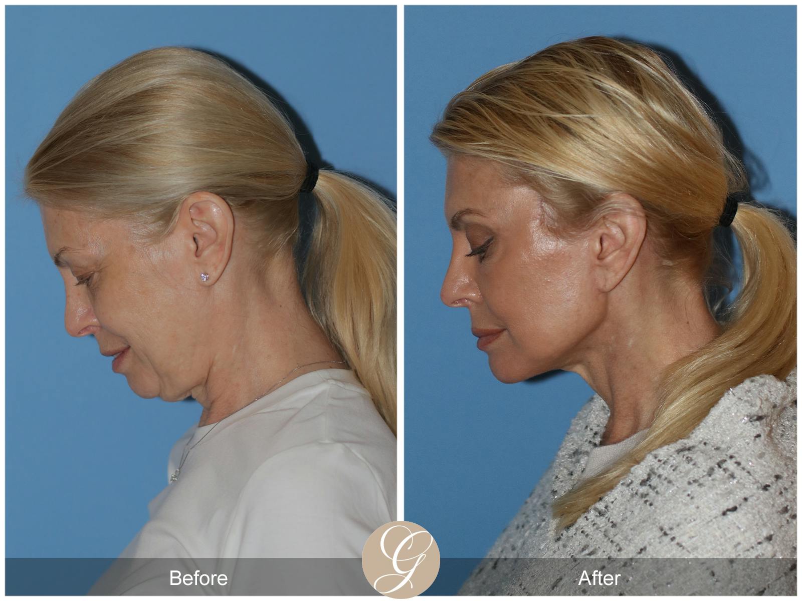 Neck Lift Before & After Gallery - Patient 222642 - Image 2
