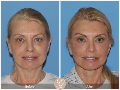 Deep Plane Facelift Before & After Gallery - Patient 273896 - Image 1