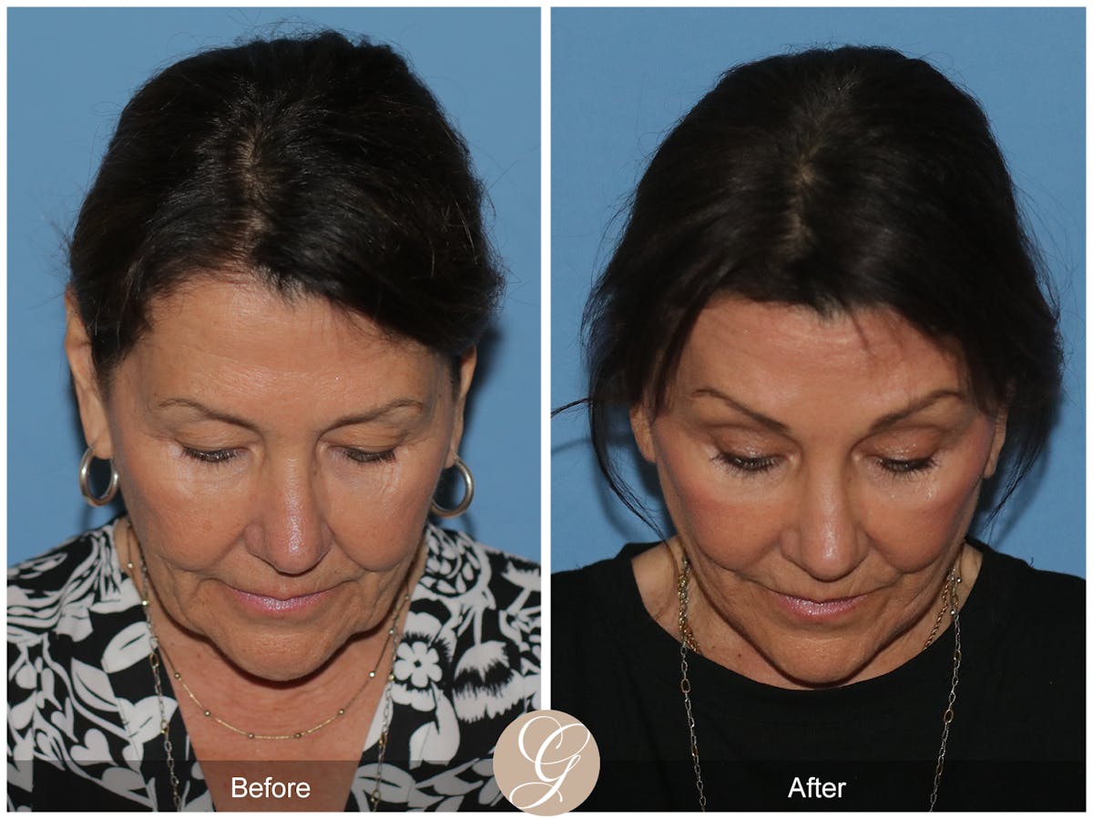 Neck Lift Before & After Gallery - Patient 256570 - Image 7
