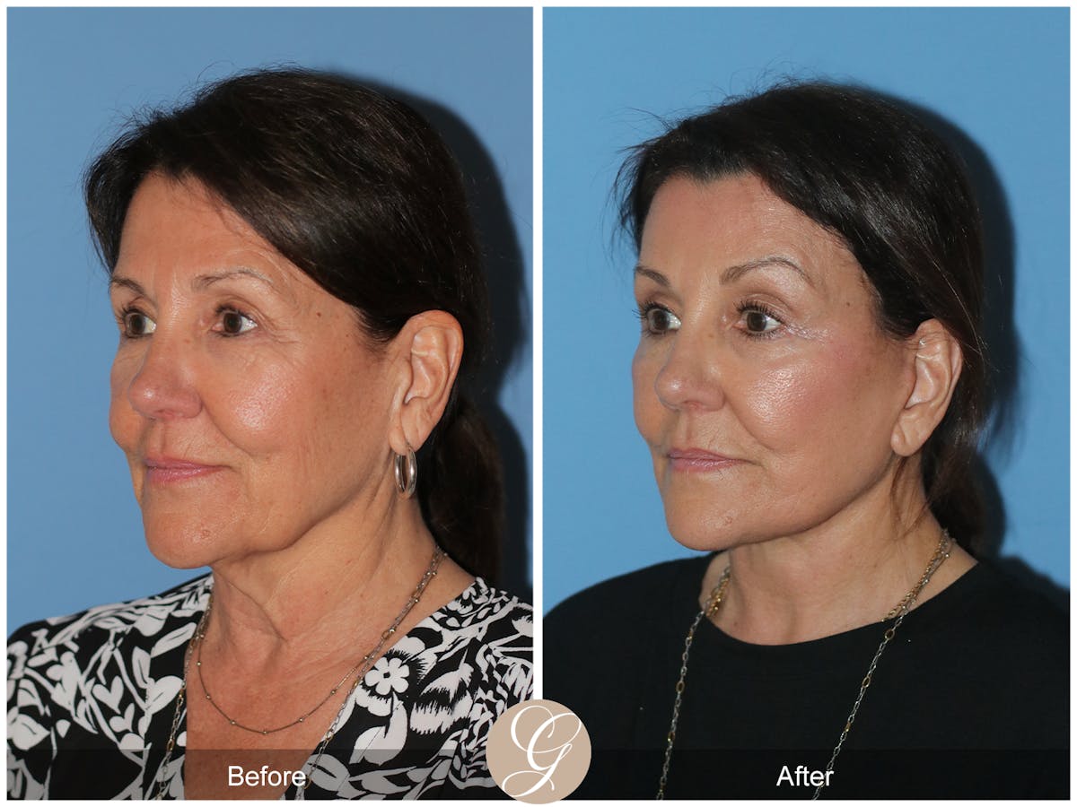 Neck Lift Before & After Gallery - Patient 256570 - Image 5