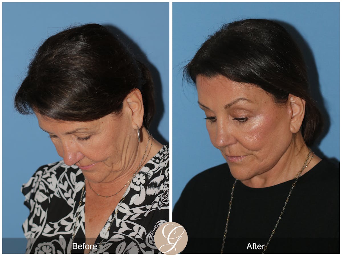 Neck Lift Before & After Gallery - Patient 256570 - Image 4