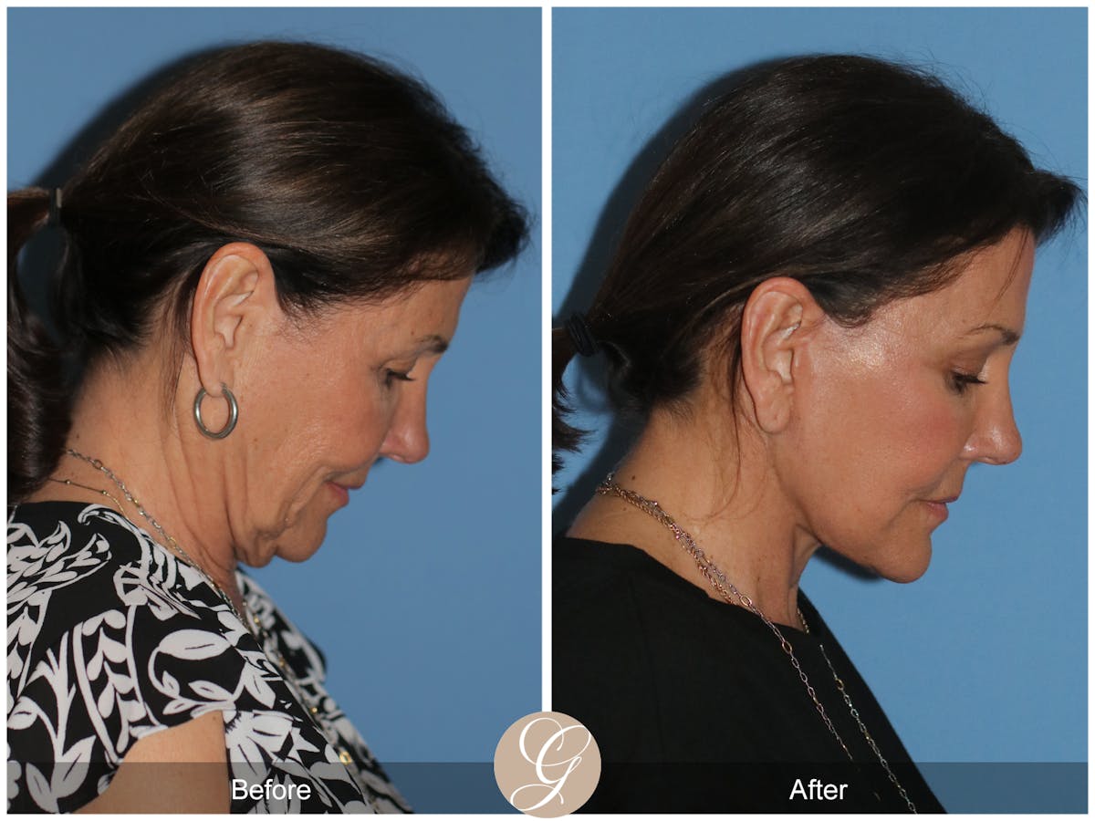 Neck Lift Before & After Gallery - Patient 256570 - Image 10