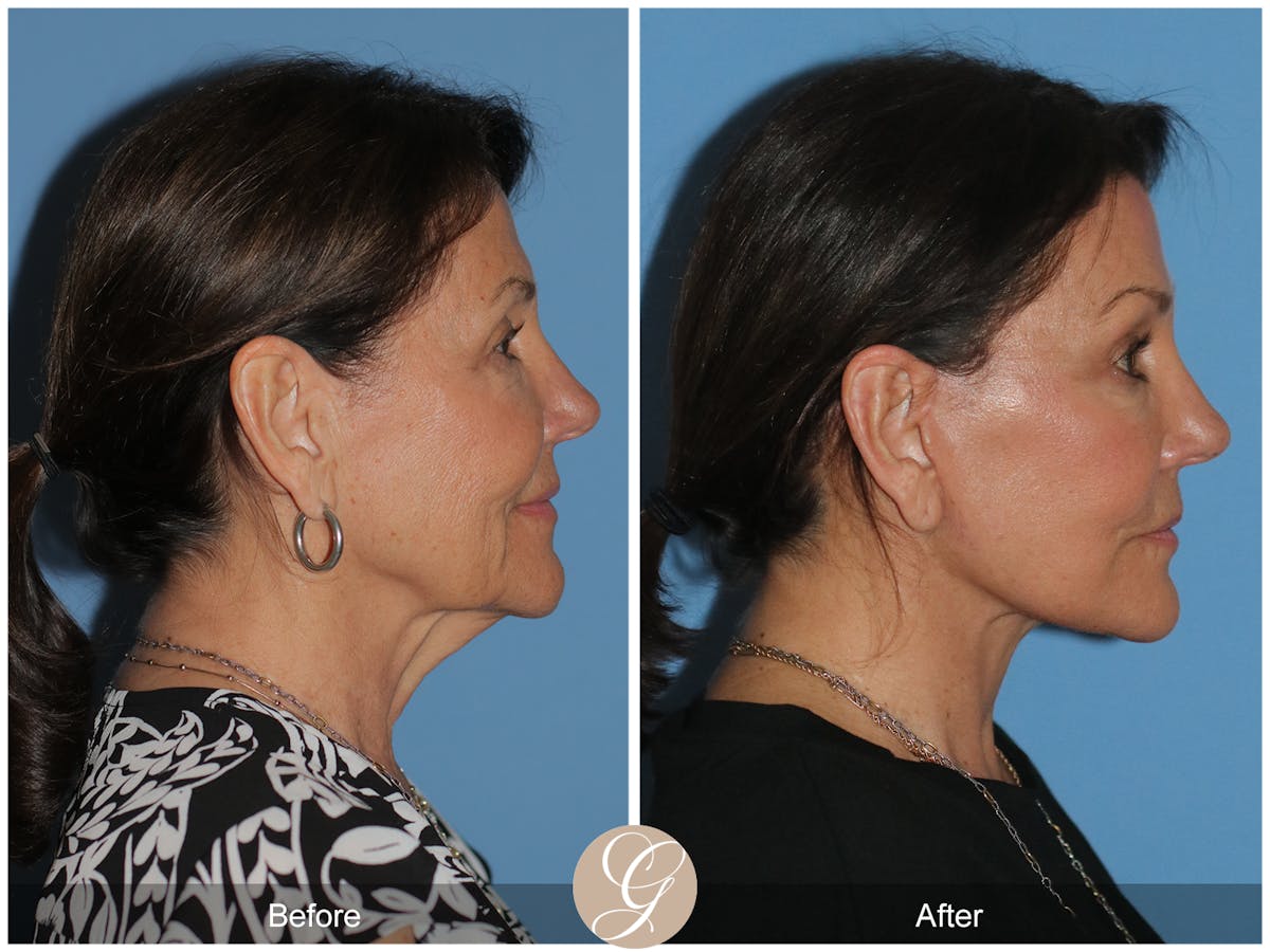 Neck Lift Before & After Gallery - Patient 256570 - Image 8