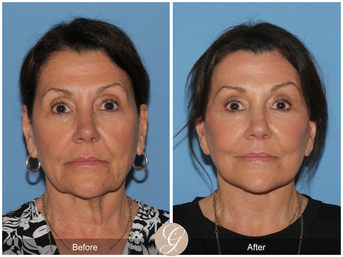 Neck Lift Before & After Gallery - Patient 256570 - Image 3