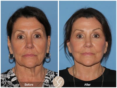 Deep Plane Facelift Before & After Gallery - Patient 935947 - Image 1