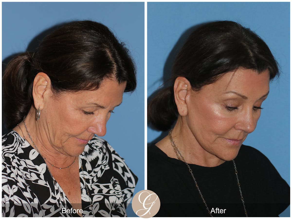 Neck Lift Before & After Gallery - Patient 256570 - Image 9