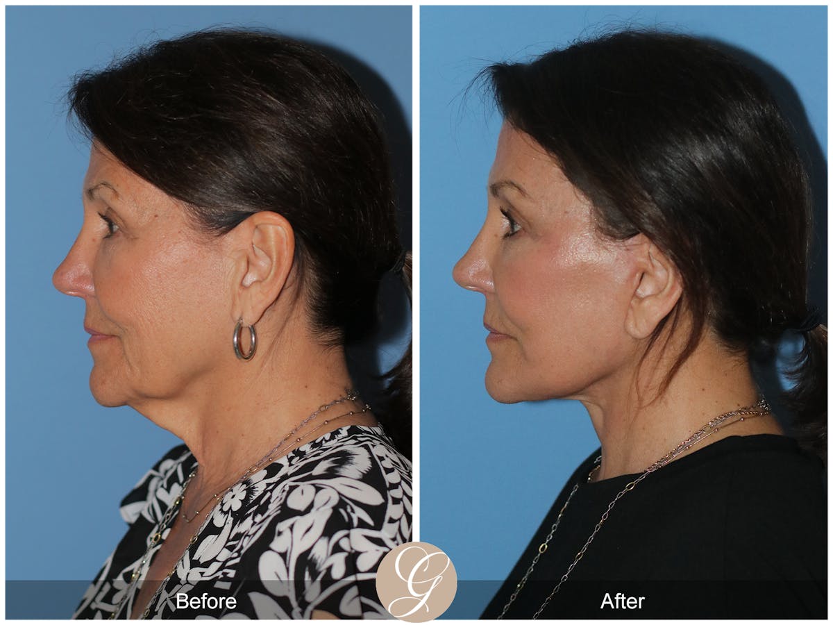 Neck Lift Before & After Gallery - Patient 256570 - Image 1