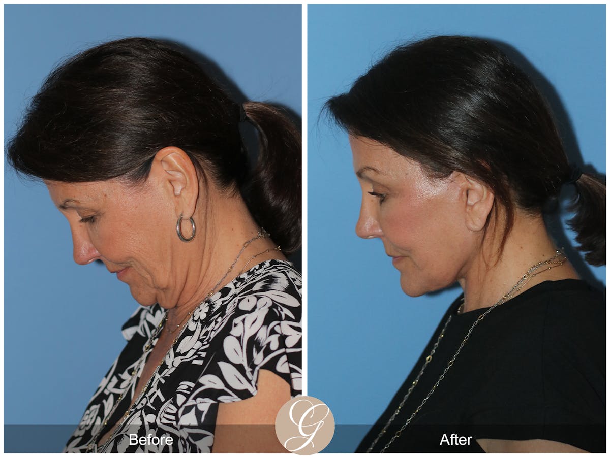 Neck Lift Before & After Gallery - Patient 256570 - Image 2
