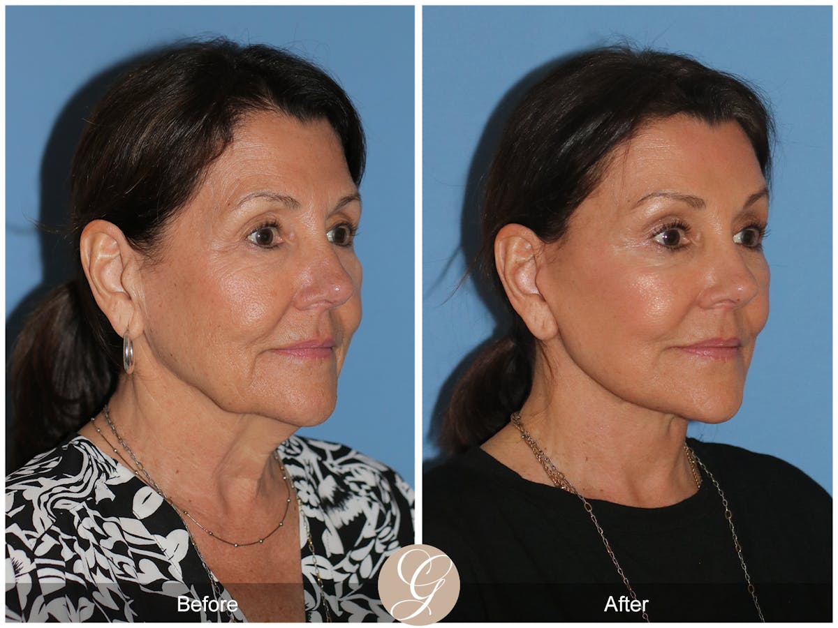 Neck Lift Before & After Gallery - Patient 256570 - Image 6