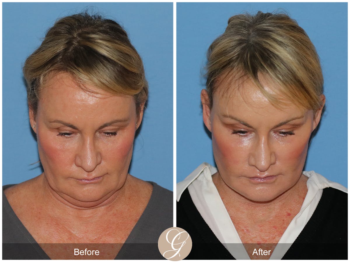 Neck Lift Before & After Gallery - Patient 185031 - Image 6